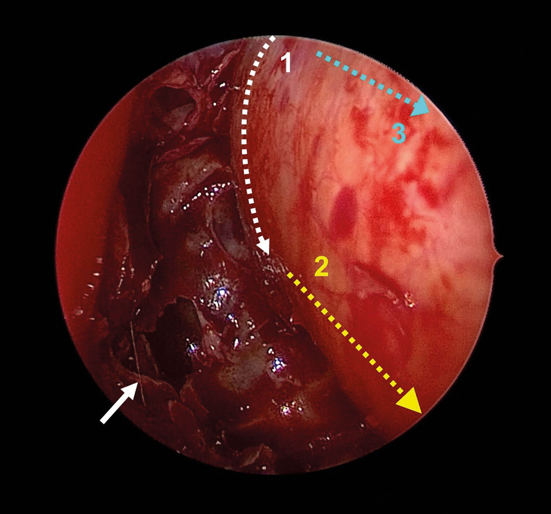 Endoscopic view showing demonstration of periorbita incisions.