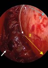 Endoscopic view showing demonstration of periorbita incisions.