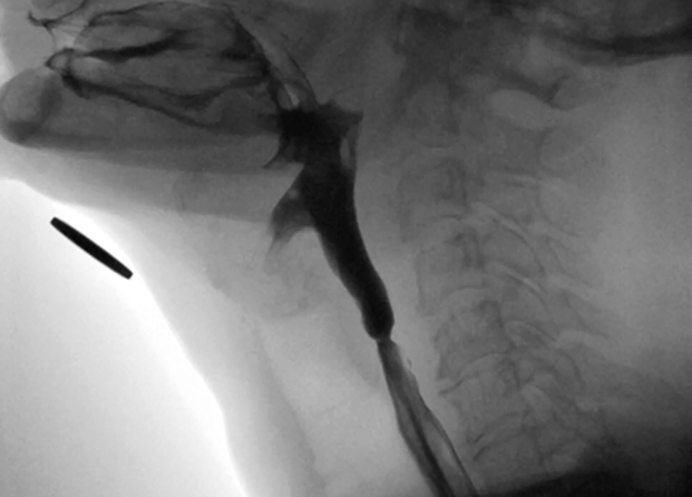 Image showing fluoroscopic lateral view of pharyngoesophageal segmaent demonstrating upper oesophageal sphincter web.