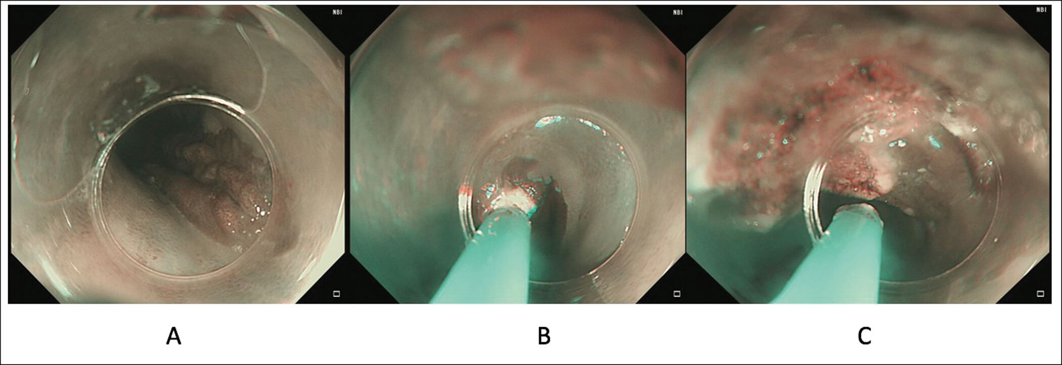 Images showing treatment of a patient with large symptomatic gastric inlet patch (A) using APC where a cap is used to provide stability in the proximal oesophagus and allow for targeted treatment (B and C).
