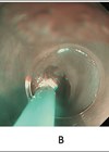 Images showing treatment of a patient with large symptomatic gastric inlet patch (A) using APC where a cap is used to provide stability in the proximal oesophagus and allow for targeted treatment (B and C).