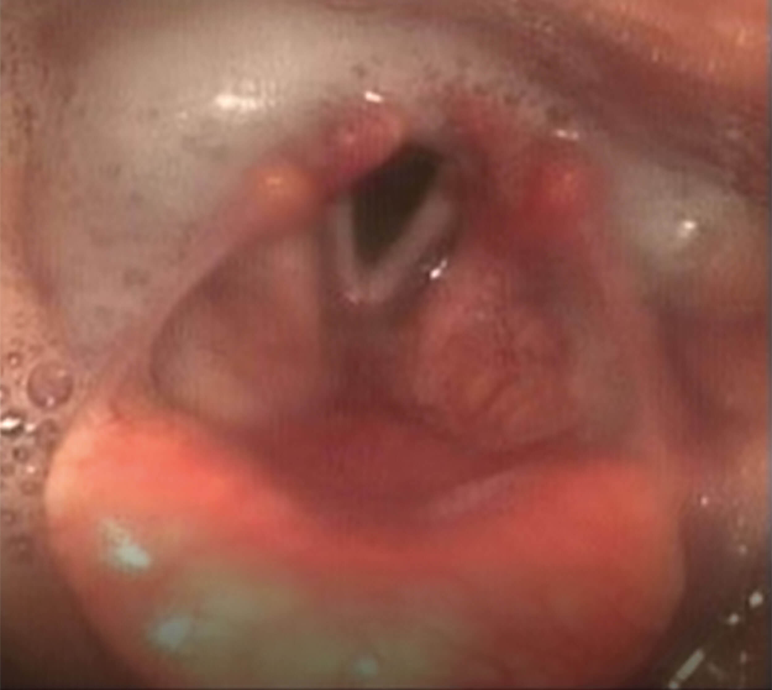 mage of pooled secretions entering posterior larynx via interarytenoid space (absent sensation) and right vocal fold palsy, with fully abducted left vocal fold in calm breathing.