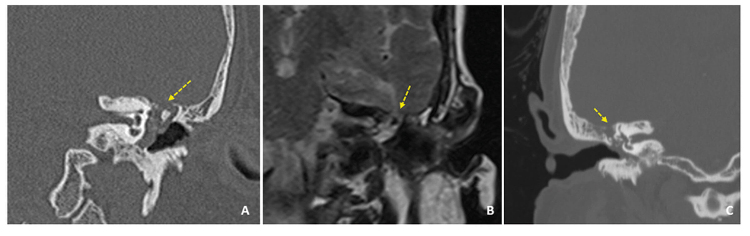 Scans showing examples of tegmen defects with meningoceles.