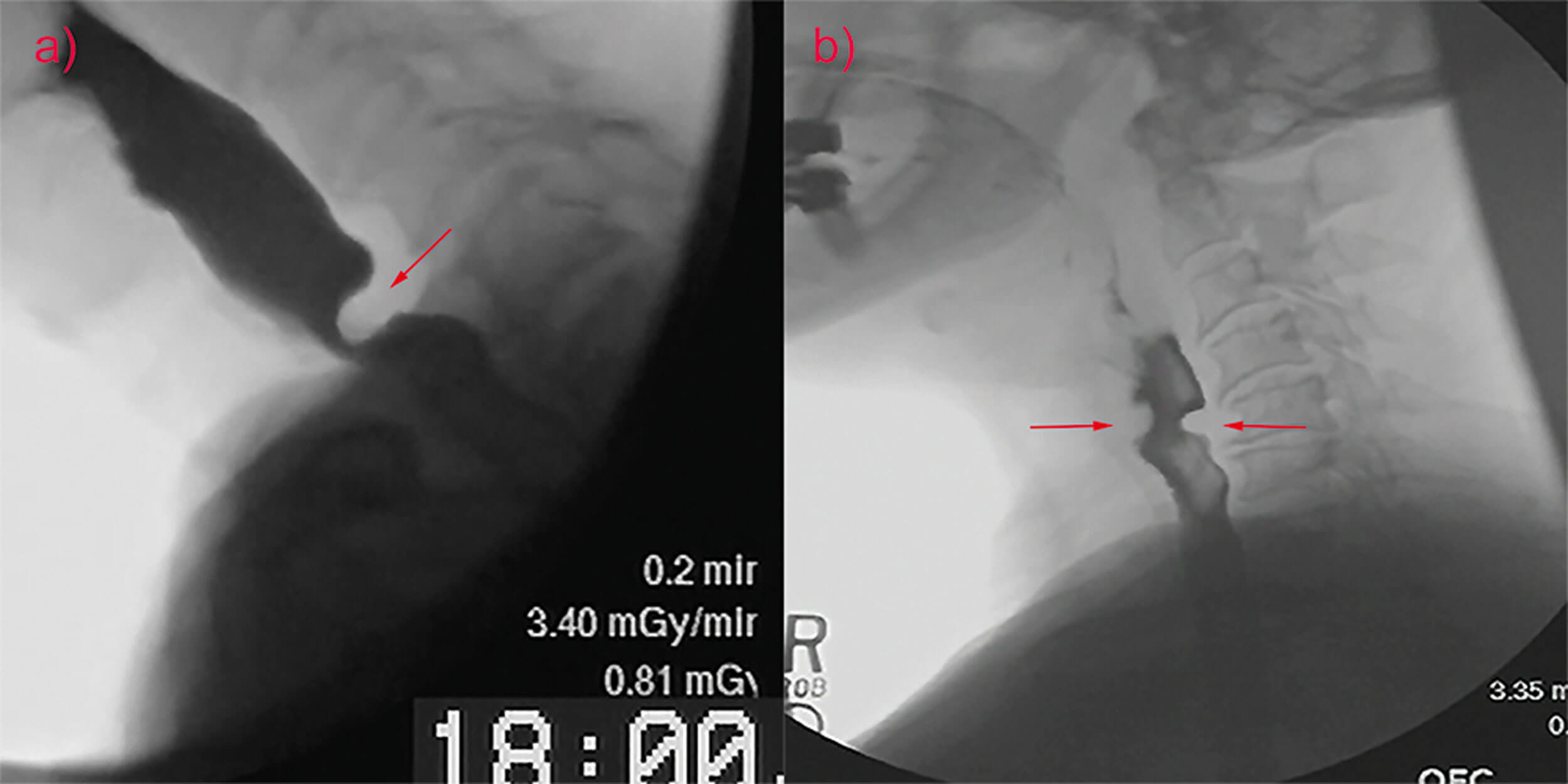 Scans showing cricopharyngeus muscle bar (a) and cricopharyngeal web (b).