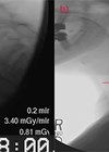 Scans showing cricopharyngeus muscle bar (a) and cricopharyngeal web (b). 