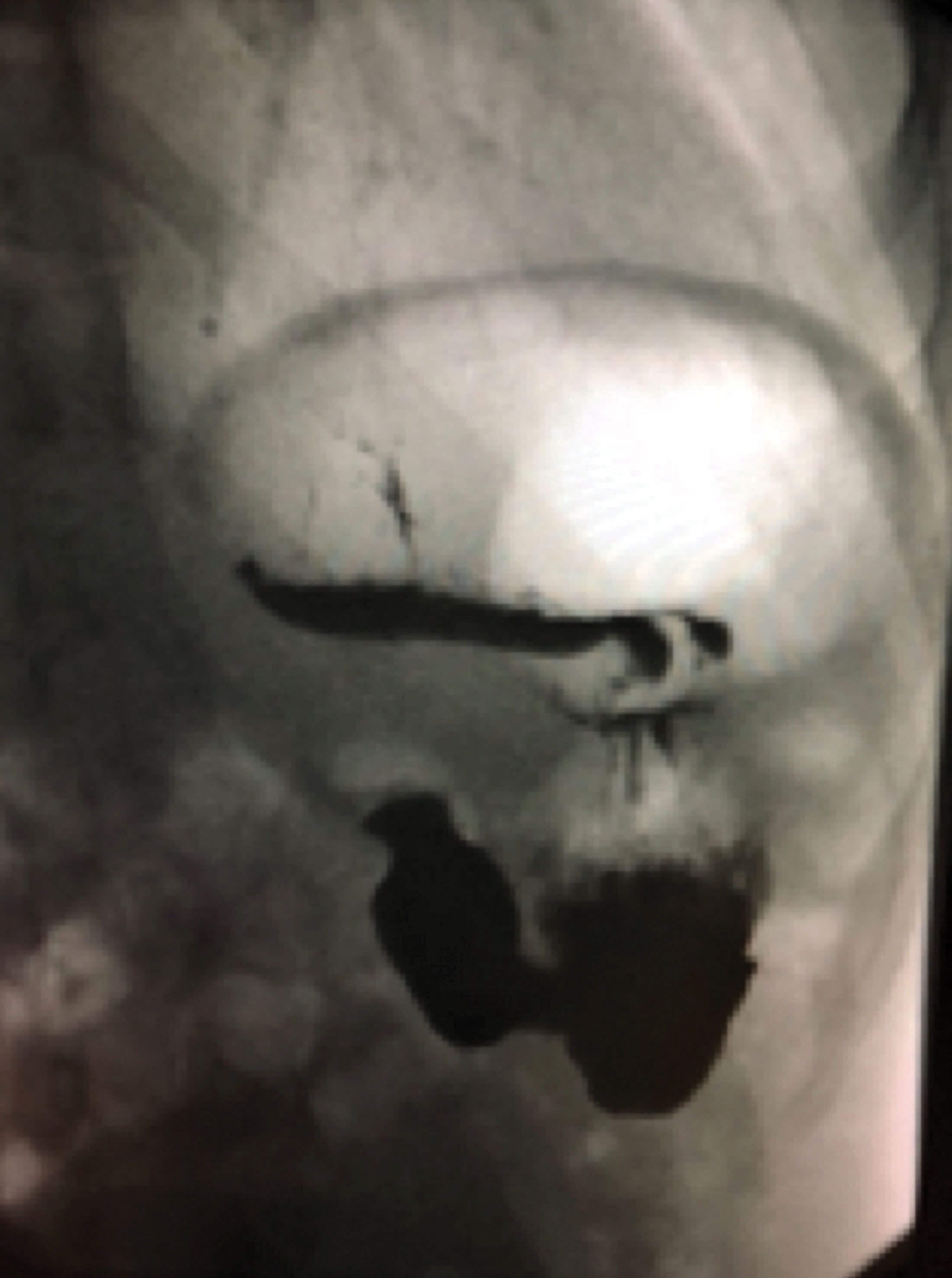 Photo showing Barium swallow showing gaseous distension of stomach.