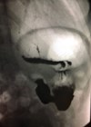 Photo showing Barium swallow showing gaseous distension of stomach.