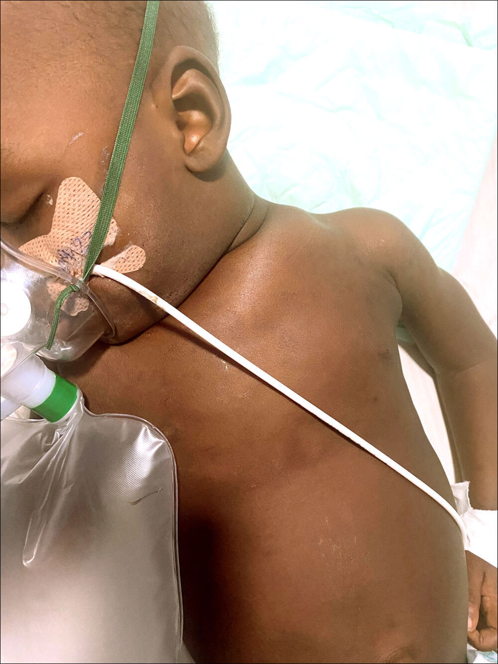 Photo of a one-year-old child who aspirated peanuts for a week and with subcutaneous emphysema,