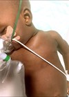 Photo of a one-year-old child who aspirated peanuts for a week and with subcutaneous emphysema,