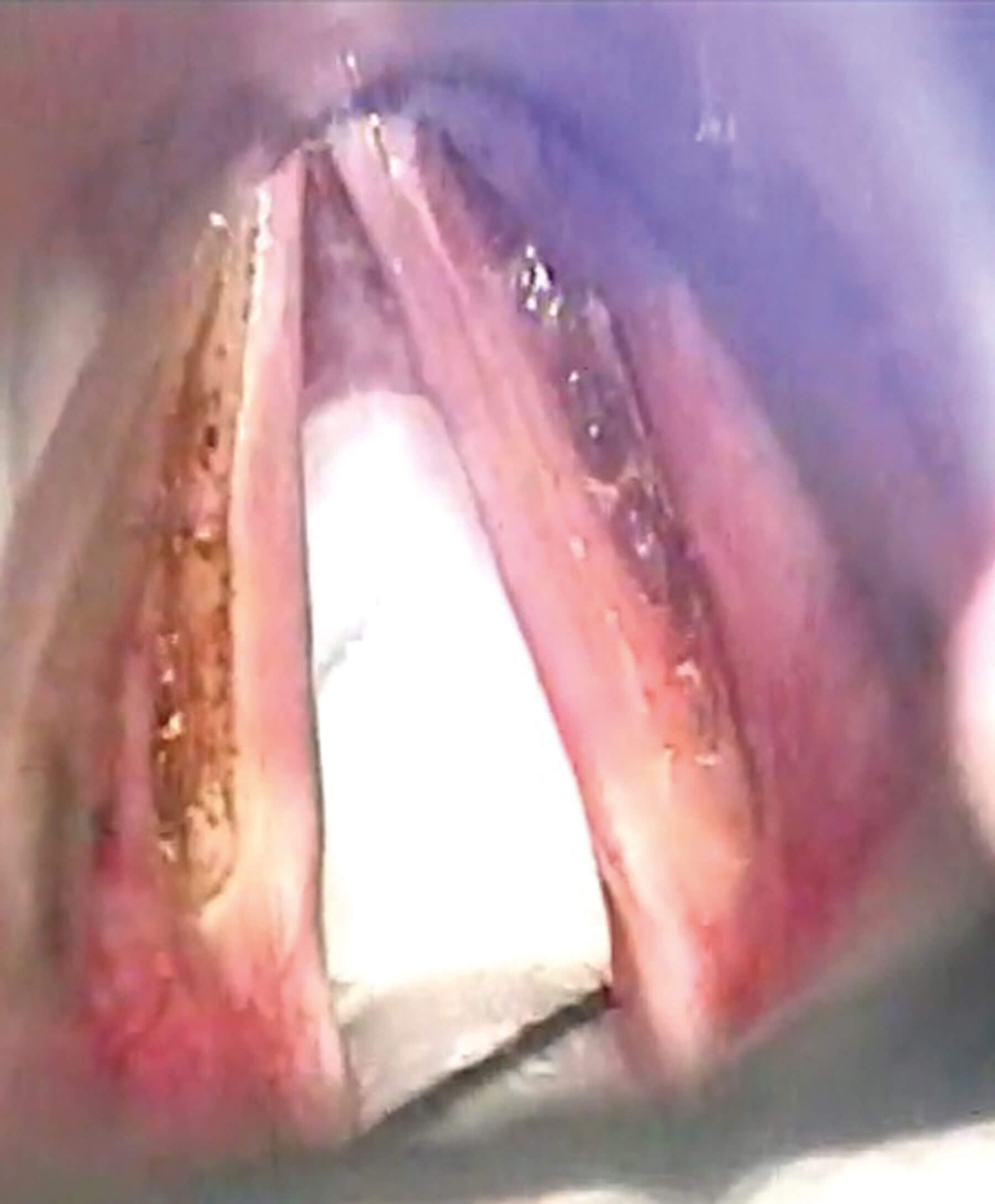 Intraoperative picture of deep LAVA on both vocal folds.