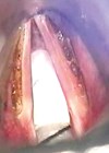 Intraoperative picture of deep LAVA on both vocal folds. 