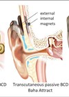 Illustrations showing examples of three different types of BCD.