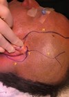 Photo showing preoperative markings on skull.