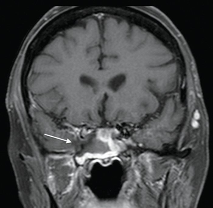 Radiology And Sinus Disease The Ever Evolving Landscape Ent Audiology News Radiology And Sinus Disease The Ever Evolving Landscape Ent Audiology News