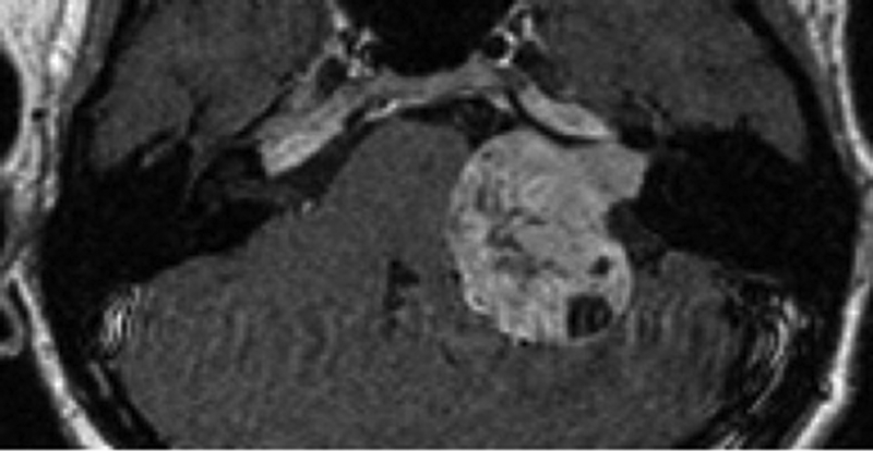 Zobrazuje se tinnitus na MRI?