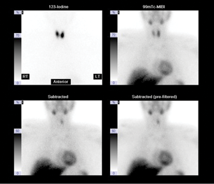 Imaging in hyperparathyroidism ENT & Audiology News