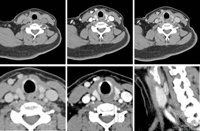 Imaging in hyperparathyroidism | ENT & Audiology News