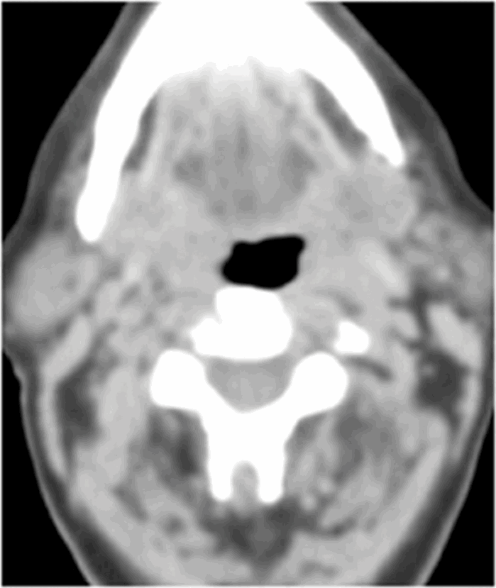 Head and neck cancer and PET-CT | ENT & Audiology News
