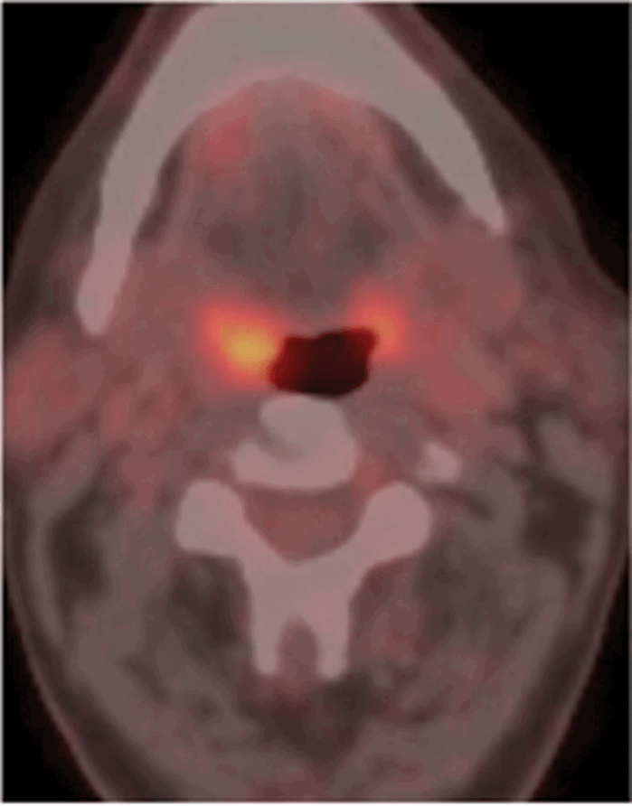 Head and neck cancer and PET-CT | ENT & Audiology News