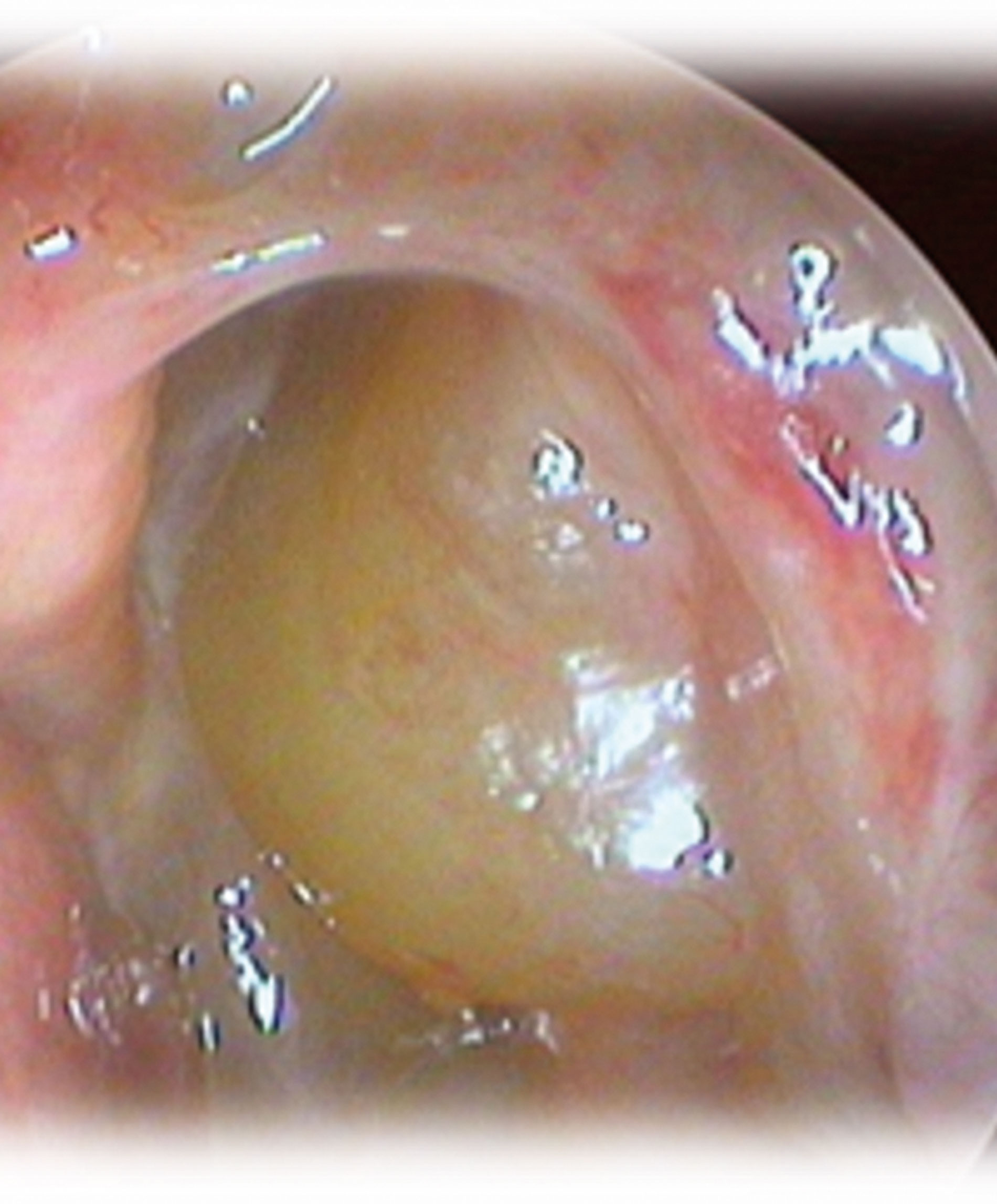 Image showing Chronic rhinosinusitis with nasal polyps. 