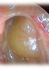 Image showing Chronic rhinosinusitis with nasal polyps.