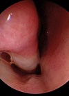 Image showing endoscopic view of right nasal cavity.