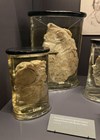 Photo showing preserved cross section of John Burley’s salivary adenoma at the Hunterian Museum, Royal College of Surgeons in London.