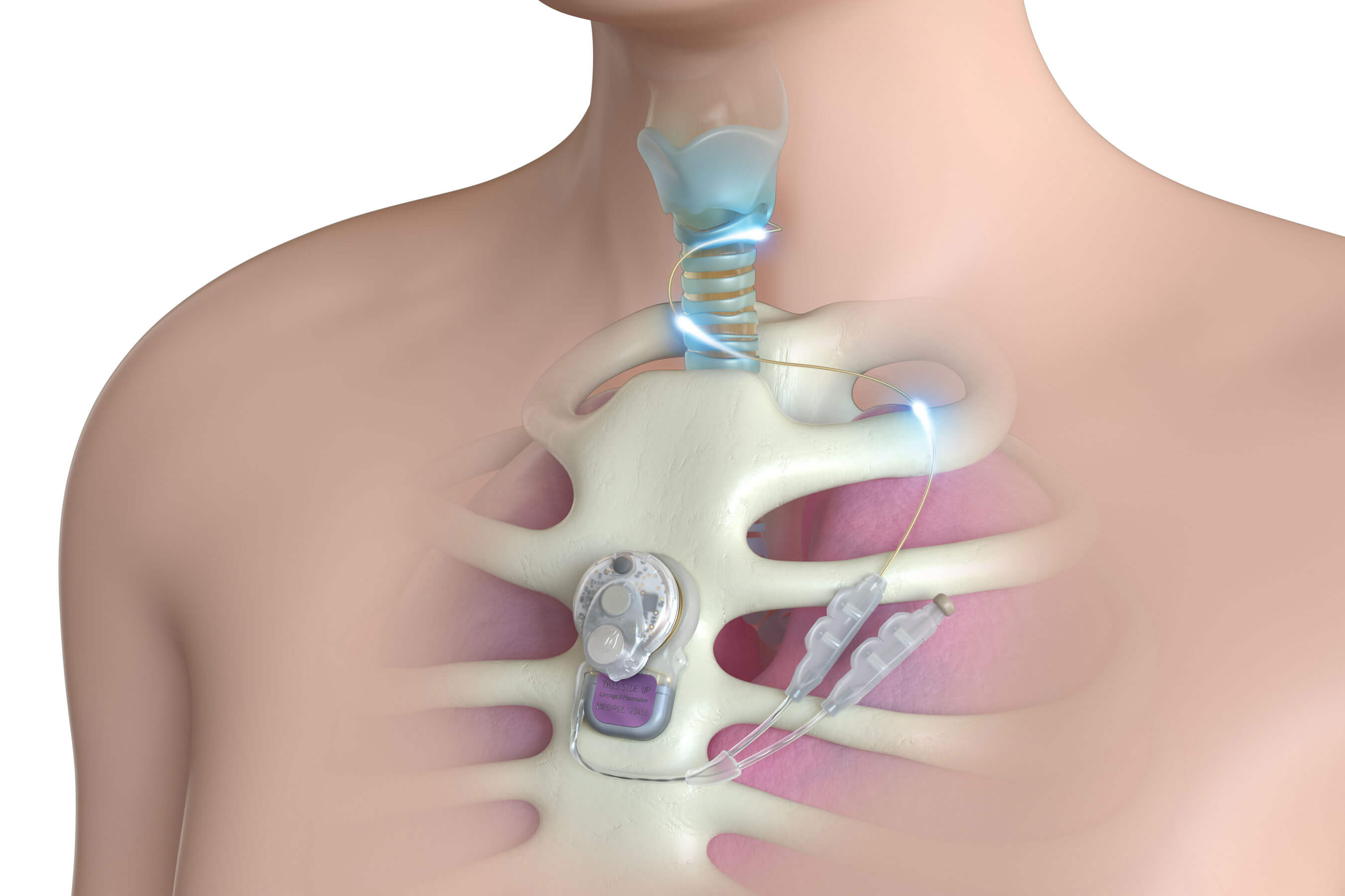 Image showing the Laryngeal Pacemaker.