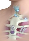 Image showing the Laryngeal Pacemaker.