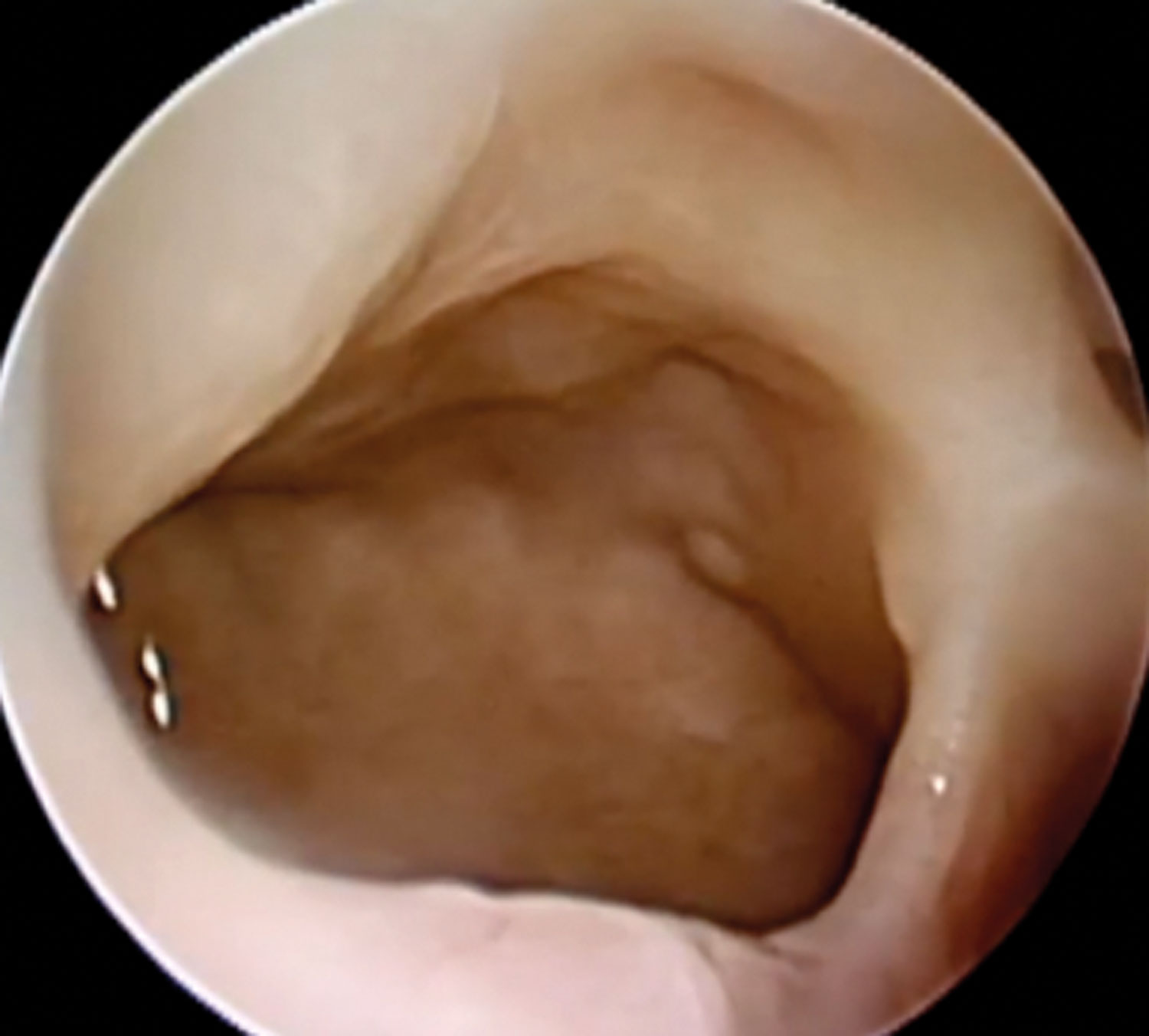 Photo showing sinus on day 45 after SNMT. 