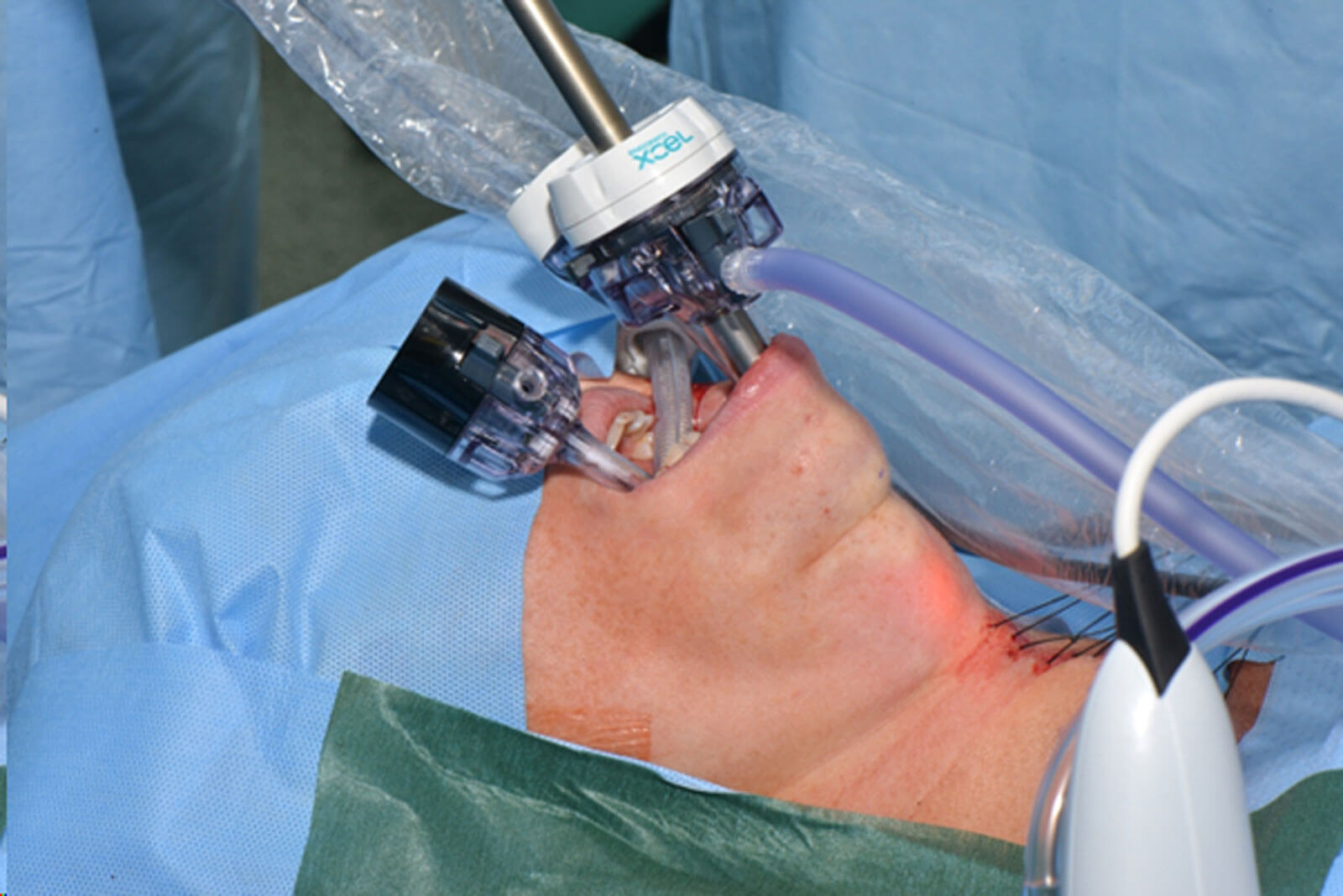 Photo showing placement of the ports.