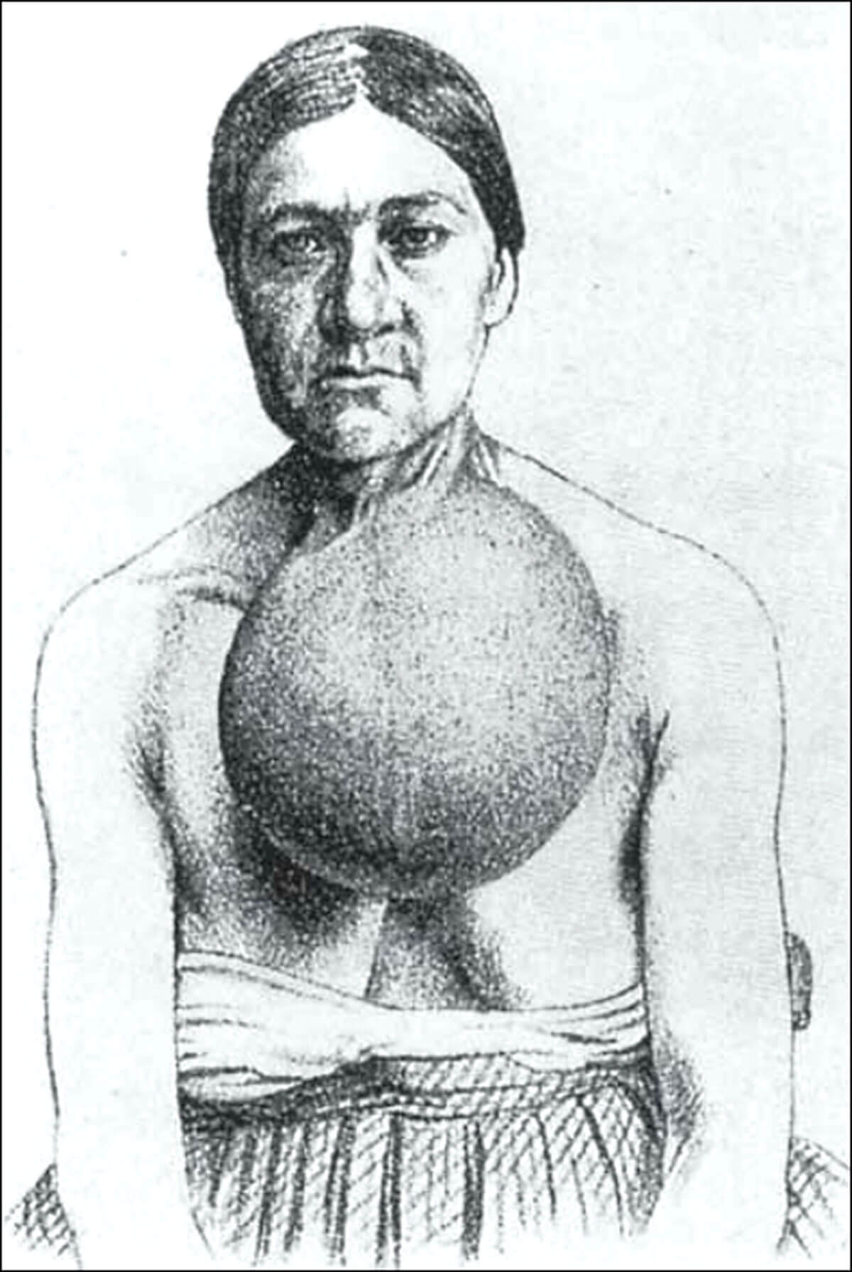 Illustration showing large goitre in a woman from Bern, Switzerland.