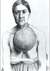 Illustration showing large goitre in a woman from Bern, Switzerland.