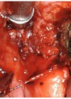 Images showing resection of a new squamous cancer in the vallecula.