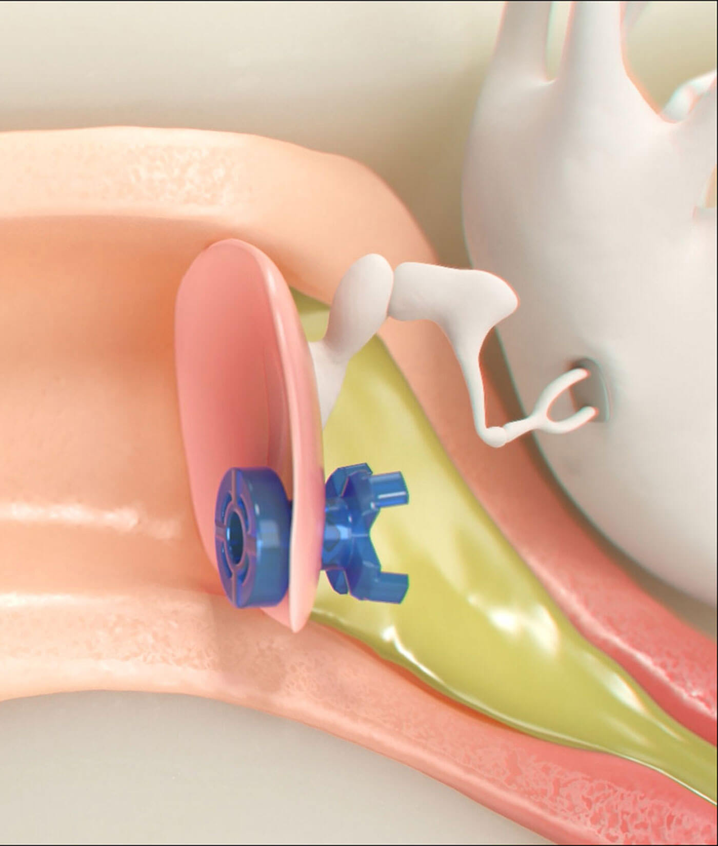 Photo showing Solo+ device in action. 