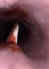 Photo showing incision with Size 11 blade.
