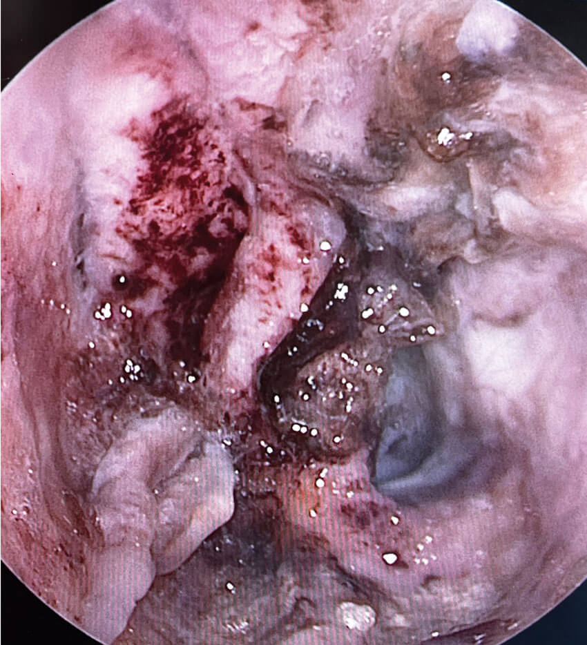 Photos showing large septal perforation before endoscopic decrusting. 