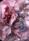 Photos showing large septal perforation before endoscopic decrusting.
