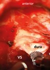 Intraoperative images of a right-sided VS resection.