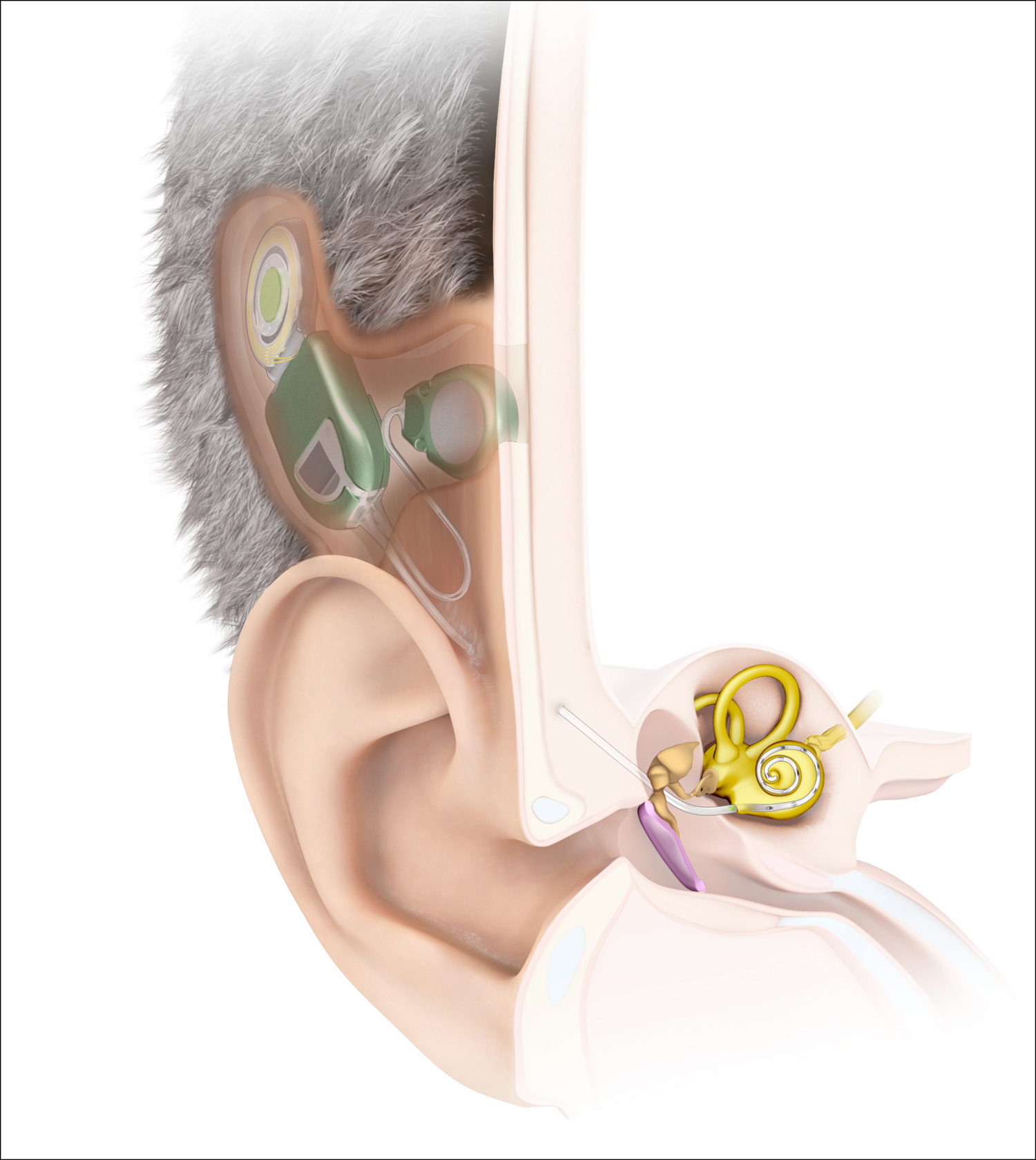 Illustration showing fully implantable cochlear implant.