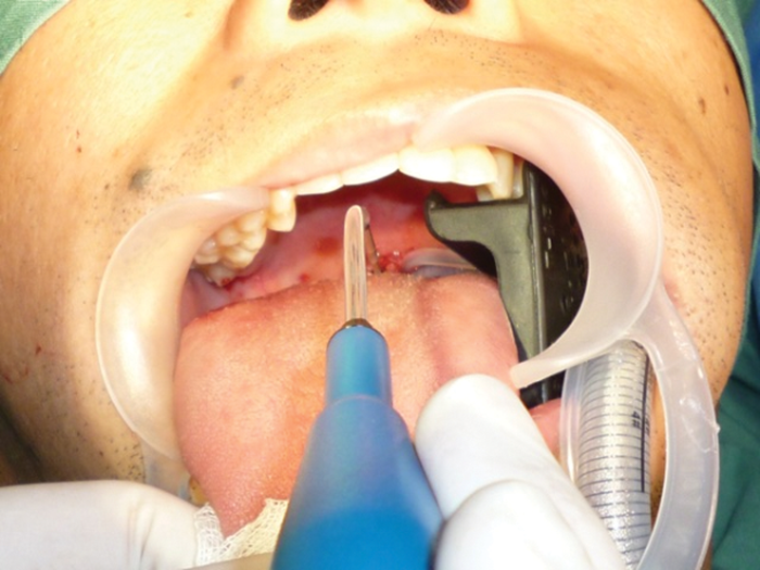 Coblation tongue channelling ENT & Audiology News
