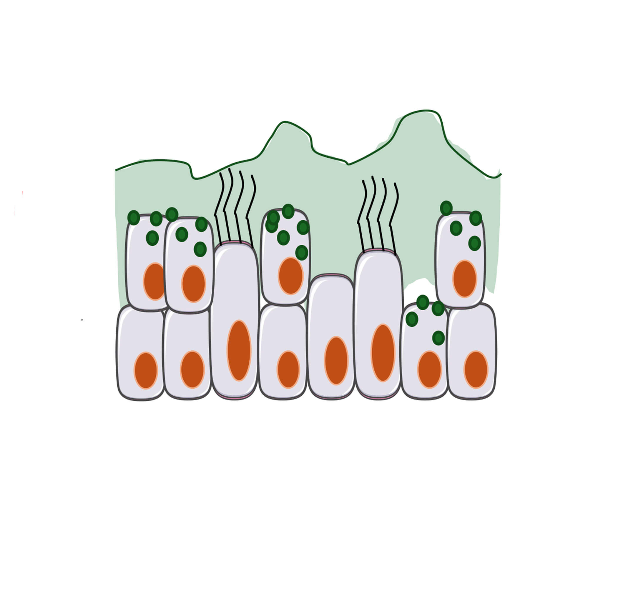 Illustration showing chronic OM.