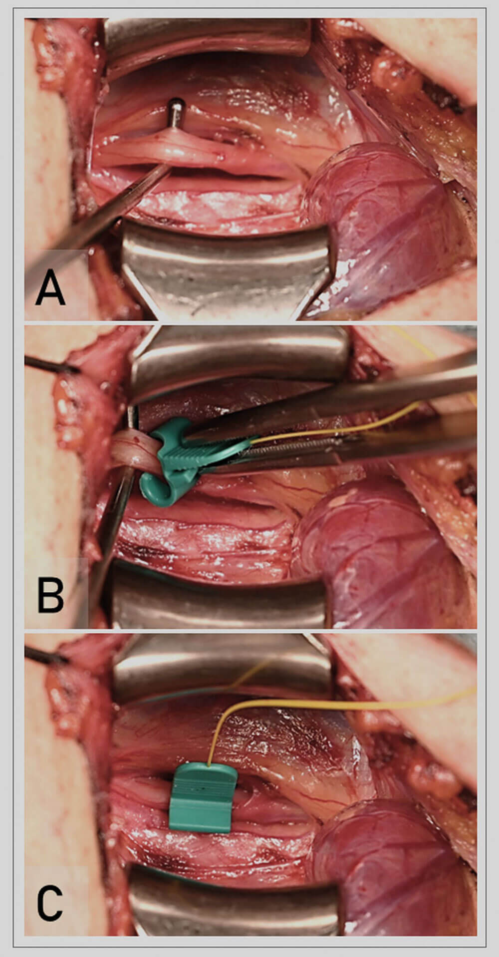 Images showing placement of the monopolar APS® electrode onto the vagus nerve before thyroid surgery.