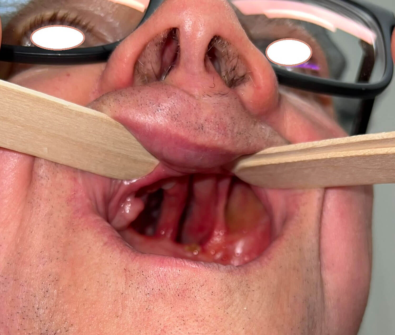 Photo showing defect of the complete hard palate following oncologic treatment.