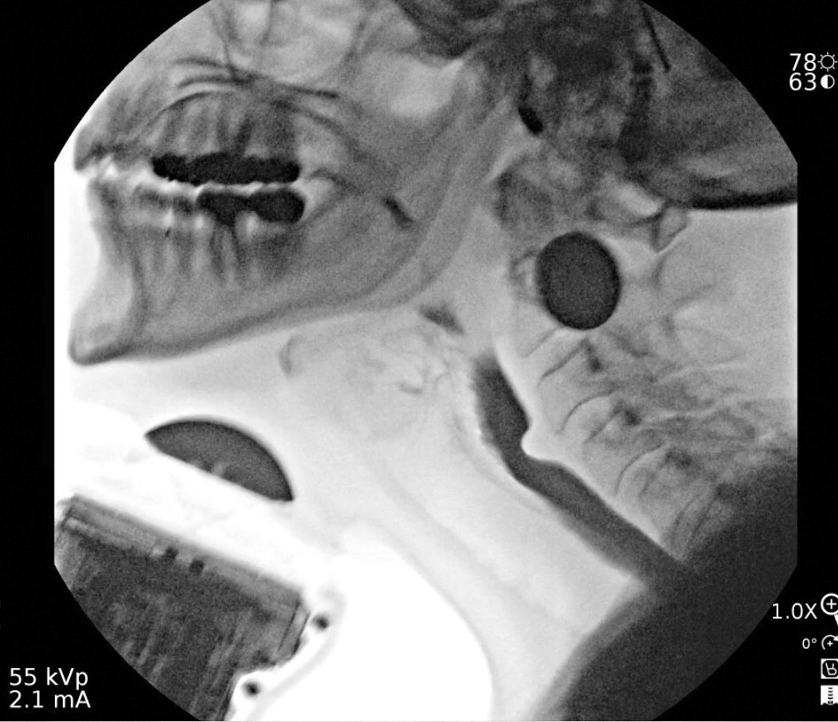Image showing patient undergoing simultaneous swallowing fluoroscopy with ultrasound and demonstrating a cricopharyngeal bar in order to diagnose cricopharyngeal muscle dysfunction (CPMD).