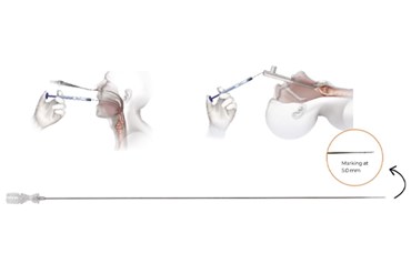 ENT Transoral NEO needle