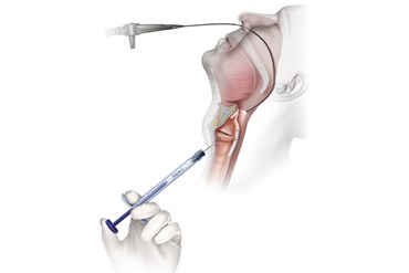 Soluvos Medical Renú® Voice Injectable Implant