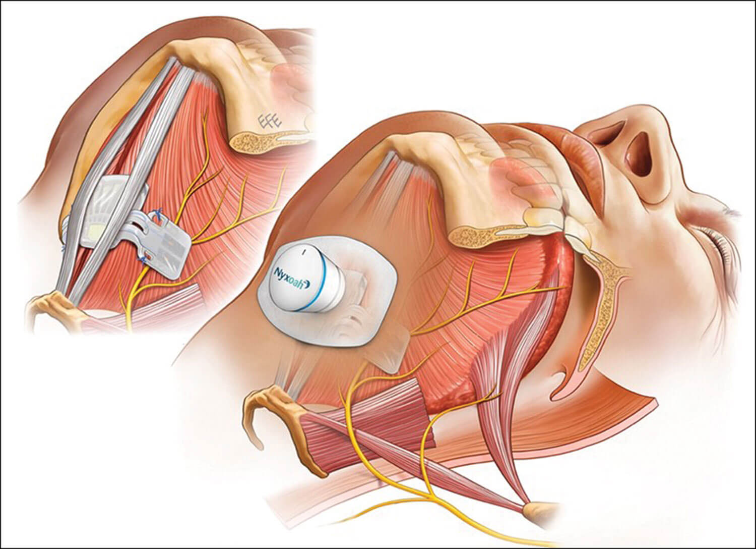 Pictorial diagram illustrating the Genio bilateral hypoglossal nerve stimulation system overlying the genioglossus muscles and hypoglossal nerves bilaterally. 
