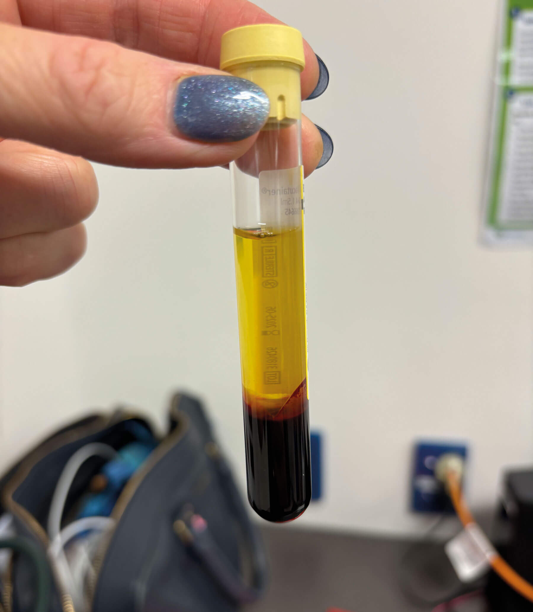 Photograph of acid-citrate-dextrose vacutainer tube after spinning whole blood in centrifuge, demonstrating the golden yellow plasma superiorly, a thin white layer (buffy coat) and the red cells inferiorly.