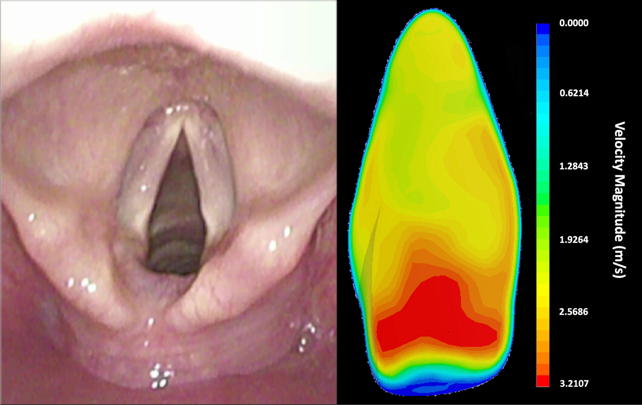 Images showing laryngeal inlet and computational fluid dynamic modelling of airflow through the glottis.  